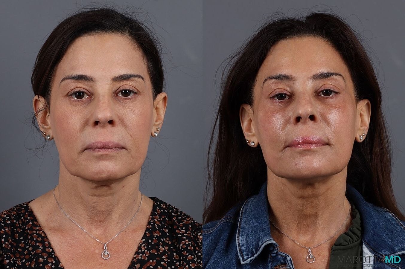 Botox Before & After