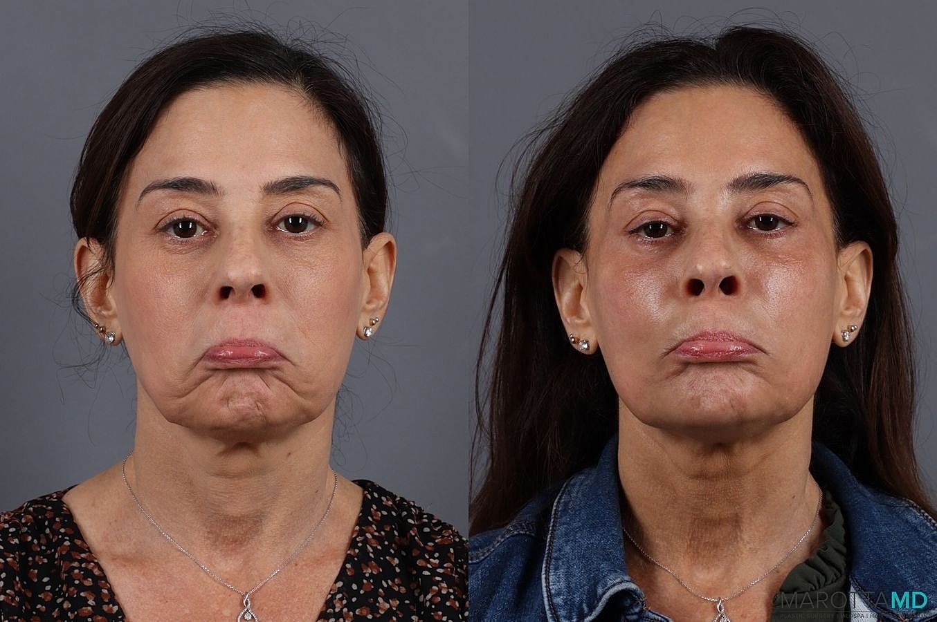 Botox Before & After
