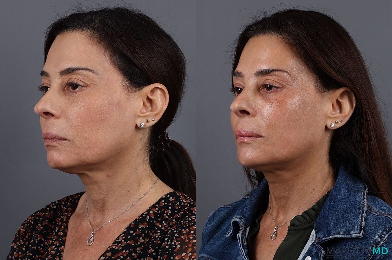 Botox Before & After