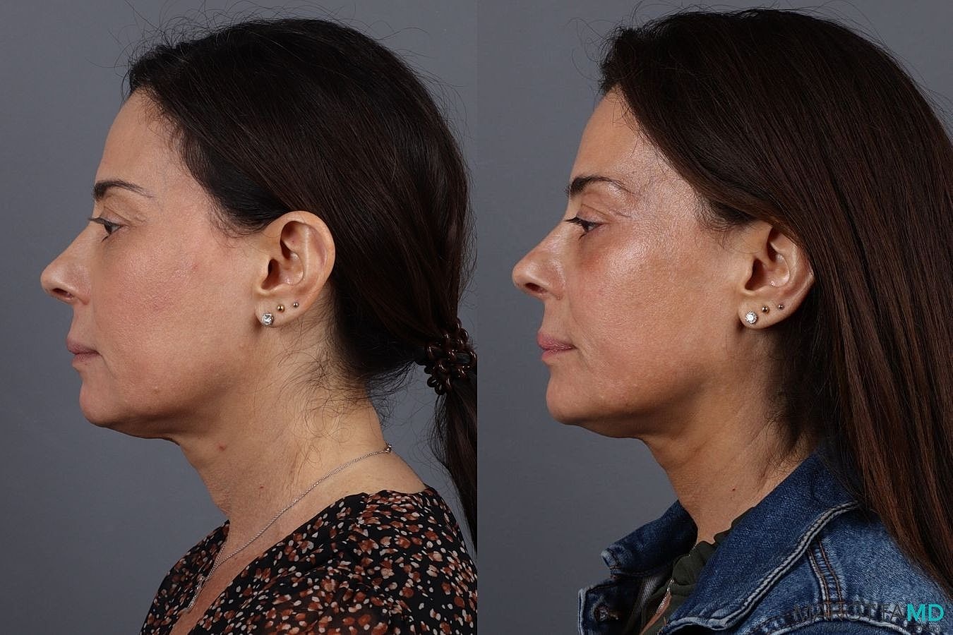 Botox Before & After