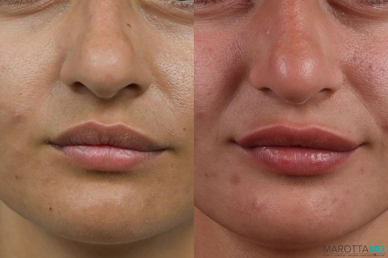 Botox Before & After
