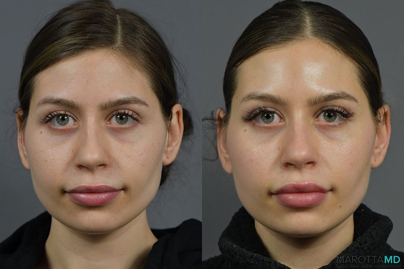Botox Before & After