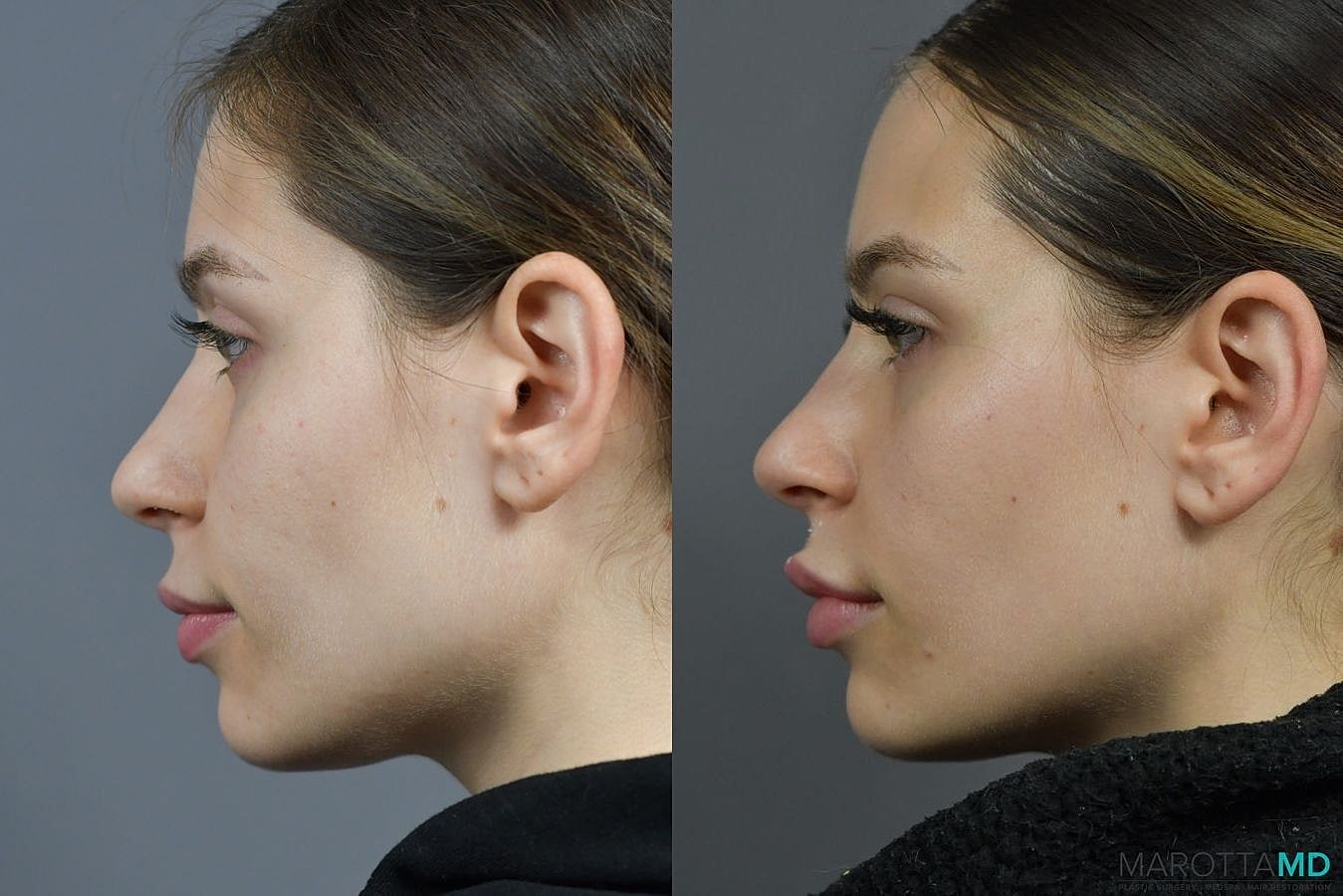 Botox Before & After