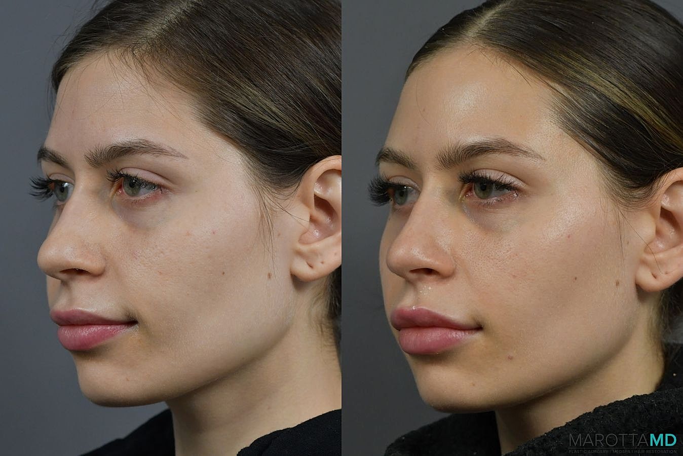Botox Before & After