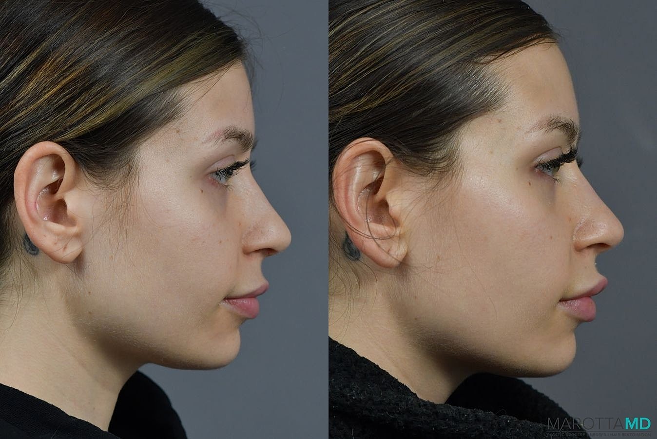Botox Before & After