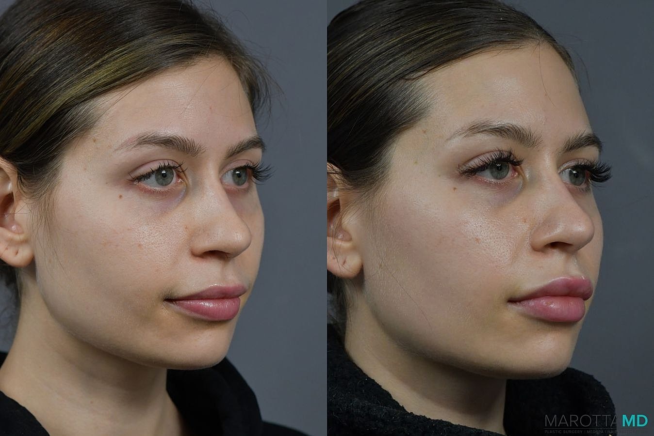 Botox Before & After