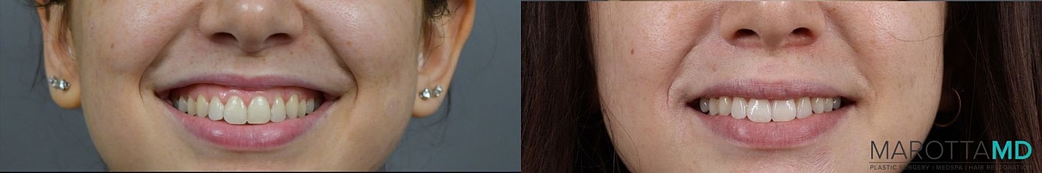 Botox Before & After