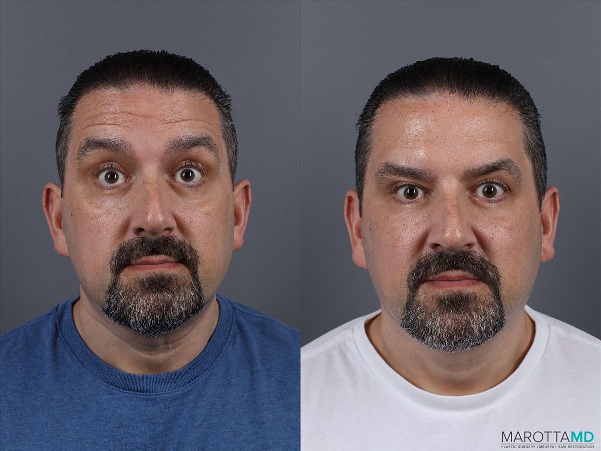 Botox Before & After