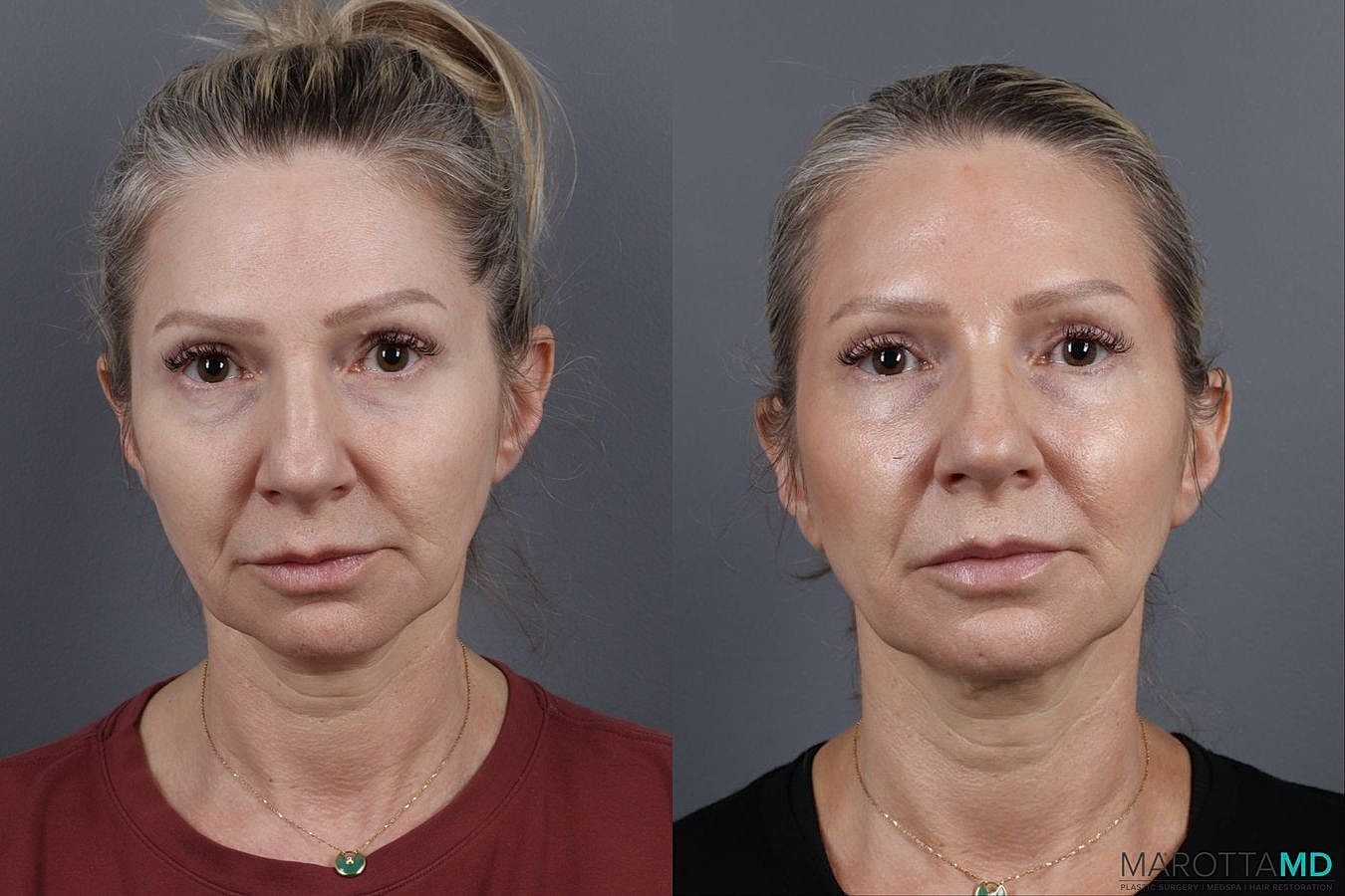 Botox Before & After