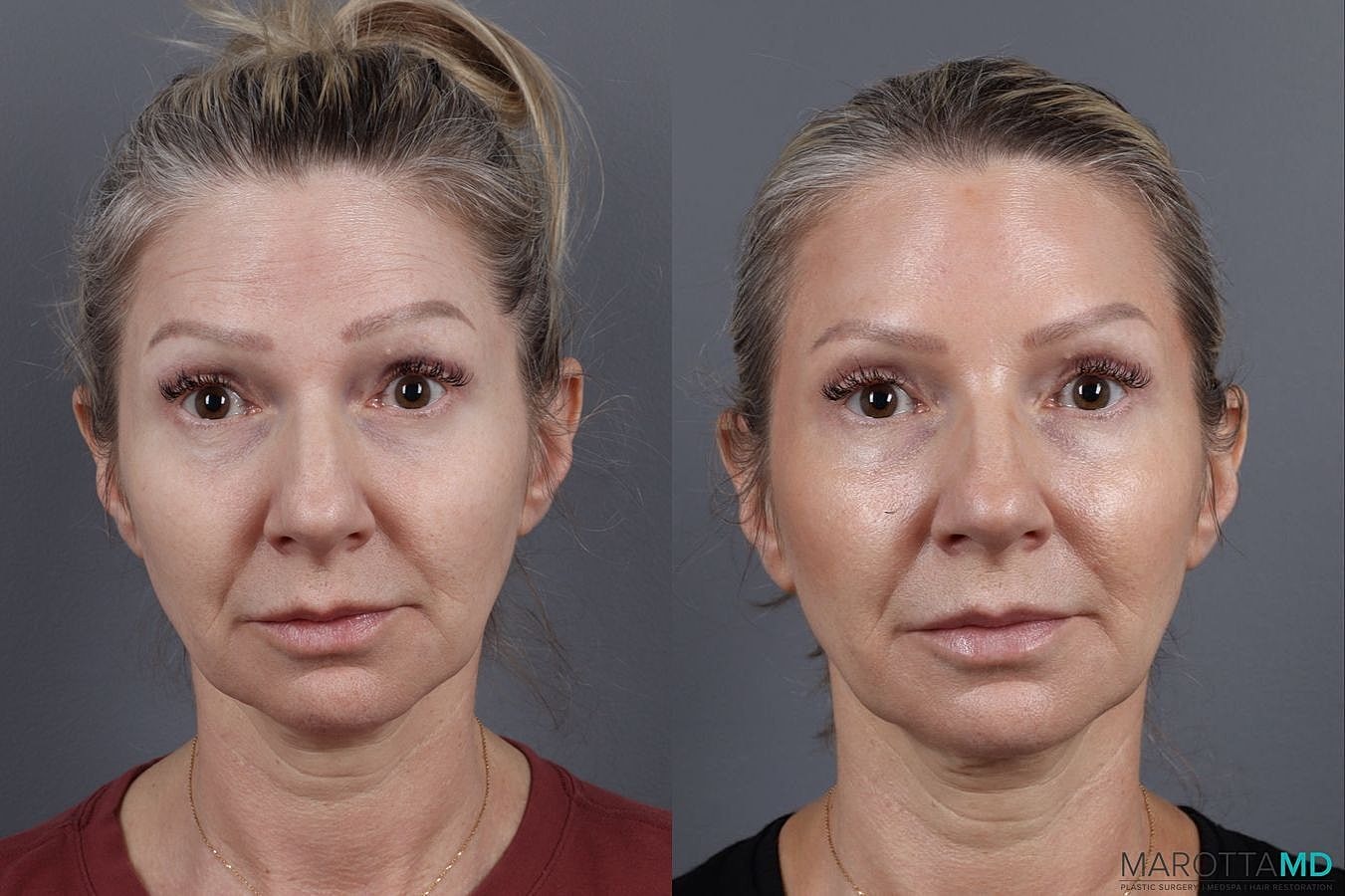 Botox Before & After