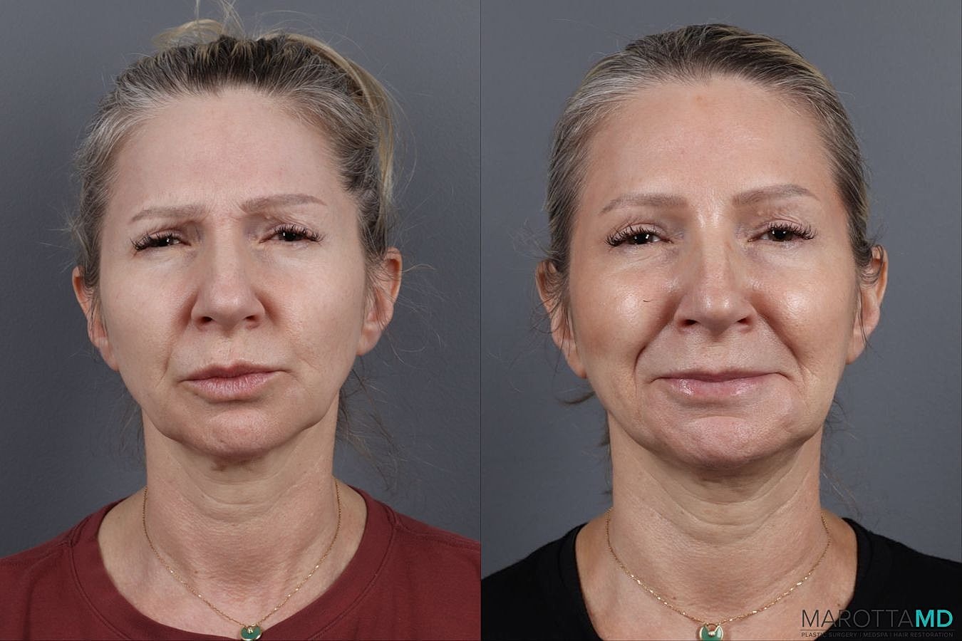 Botox Before & After