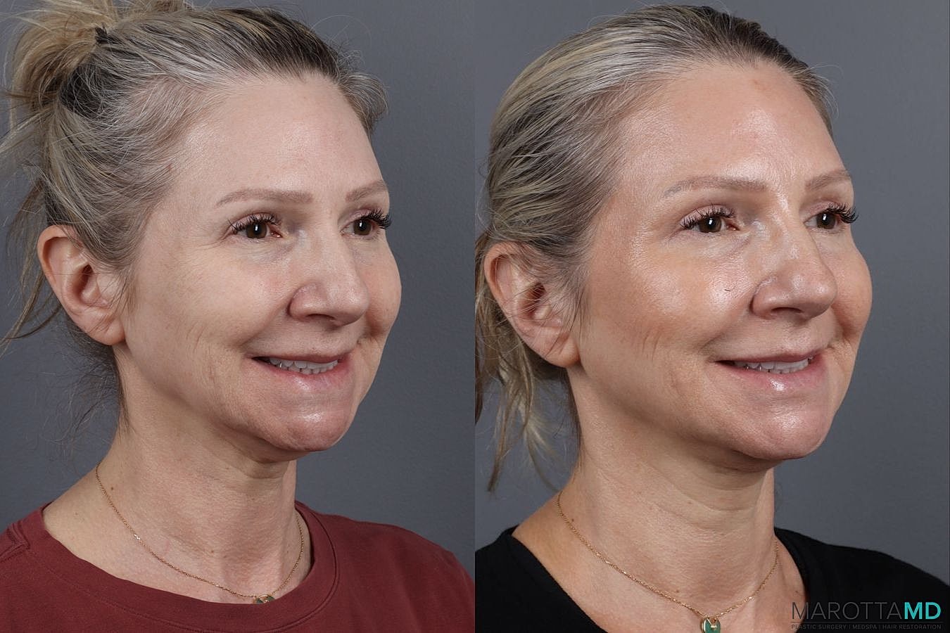 Botox Before & After
