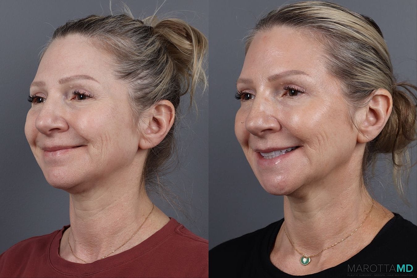 Botox Before & After