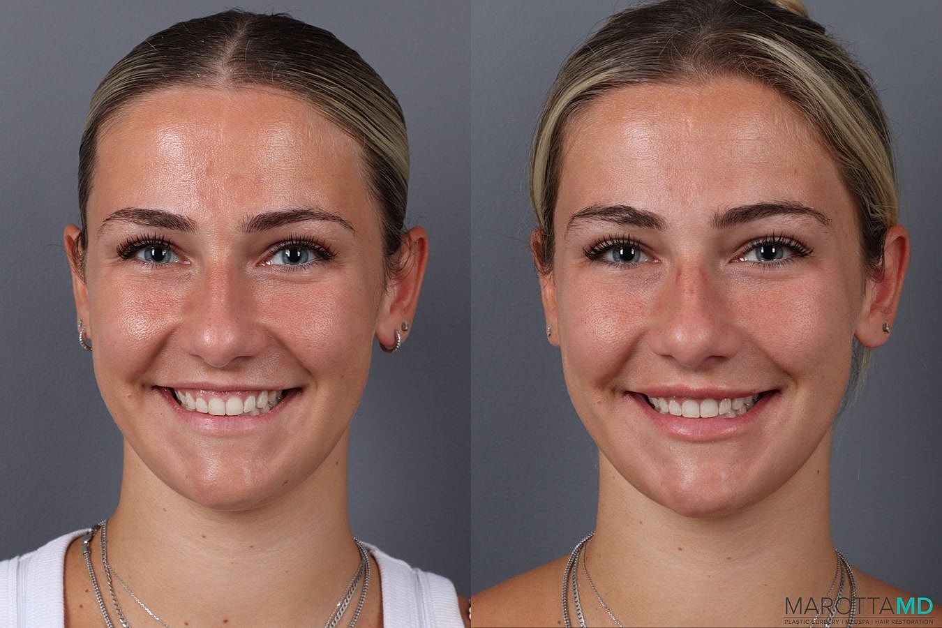 Botox Before & After