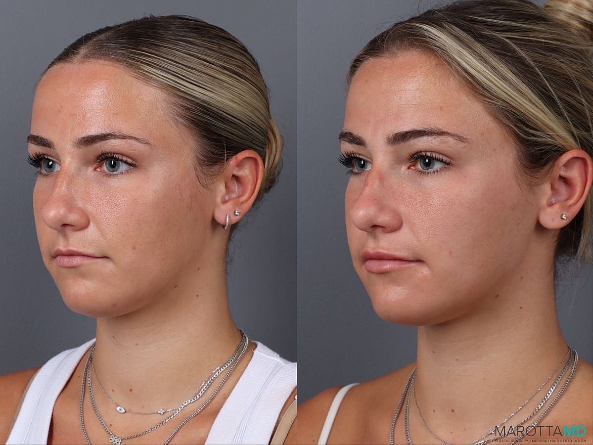 Botox Before & After