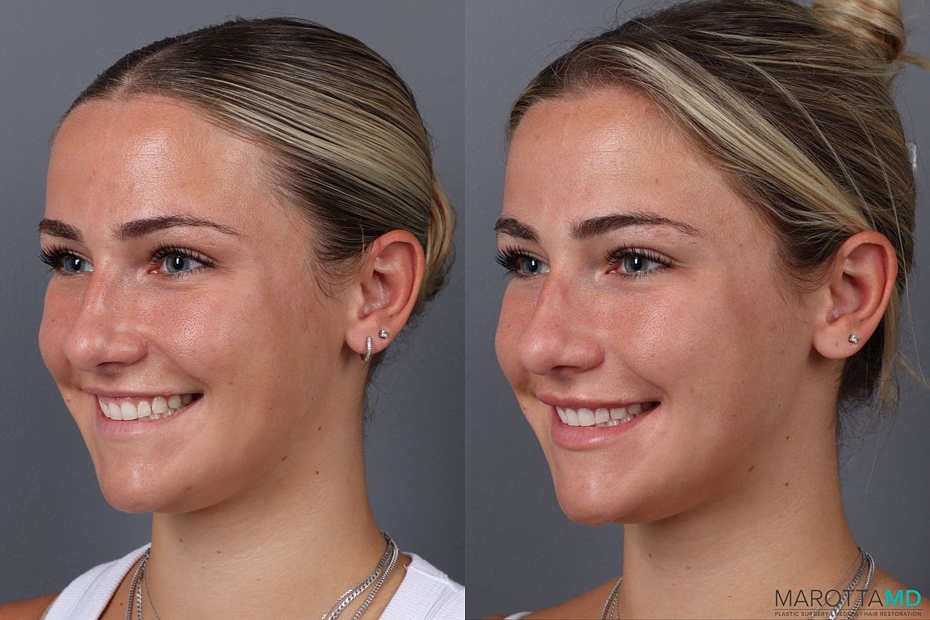 Botox Before & After