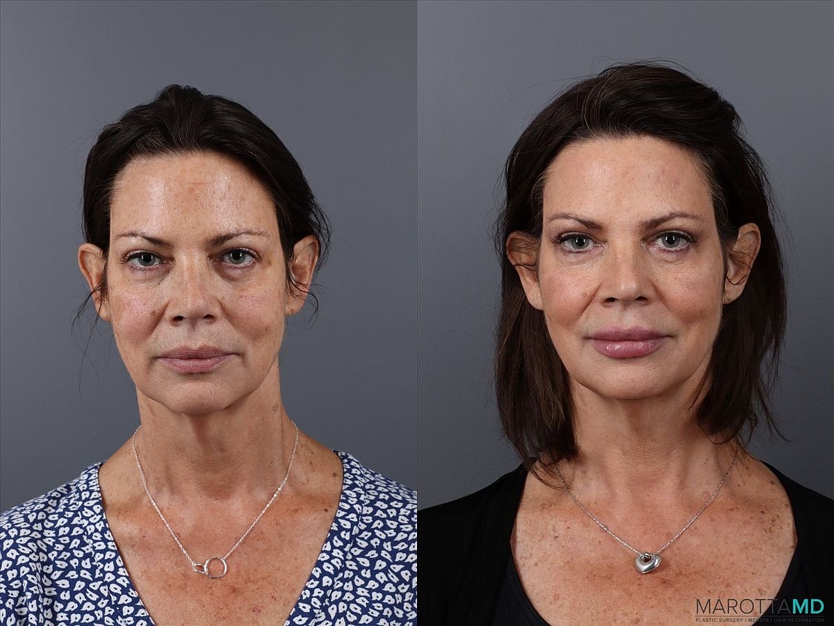 Botox Before & After