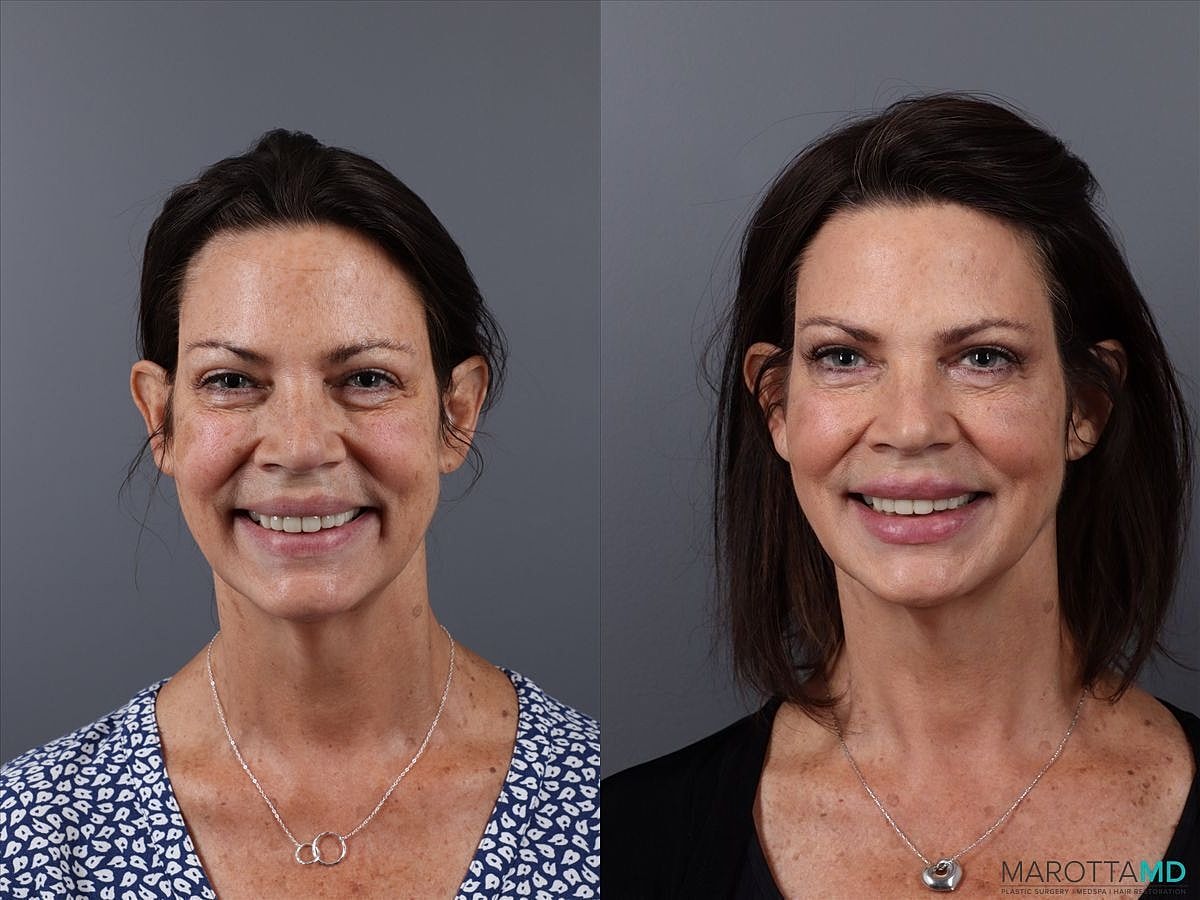 Botox Before & After
