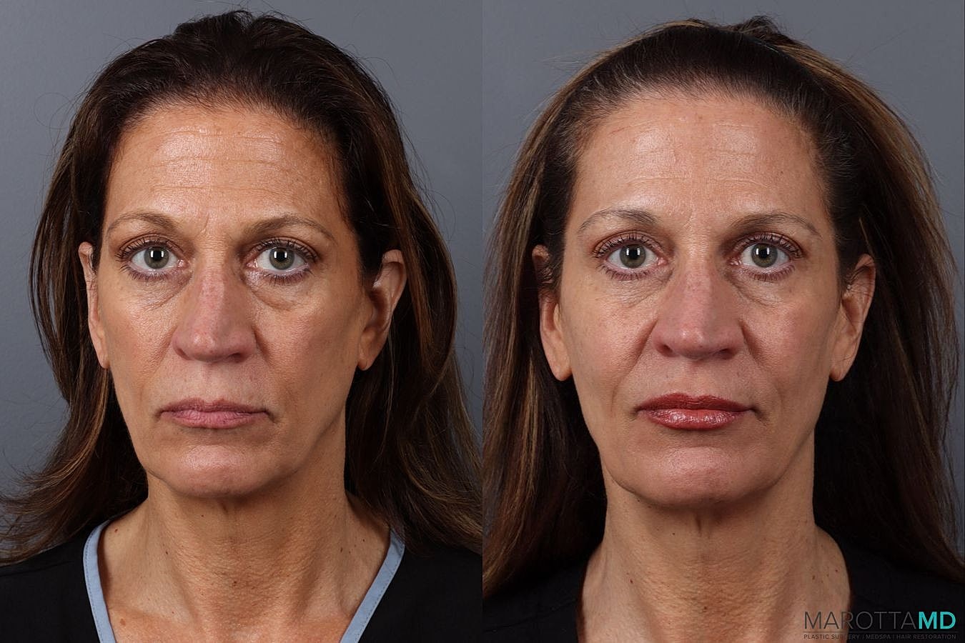 Botox Before & After
