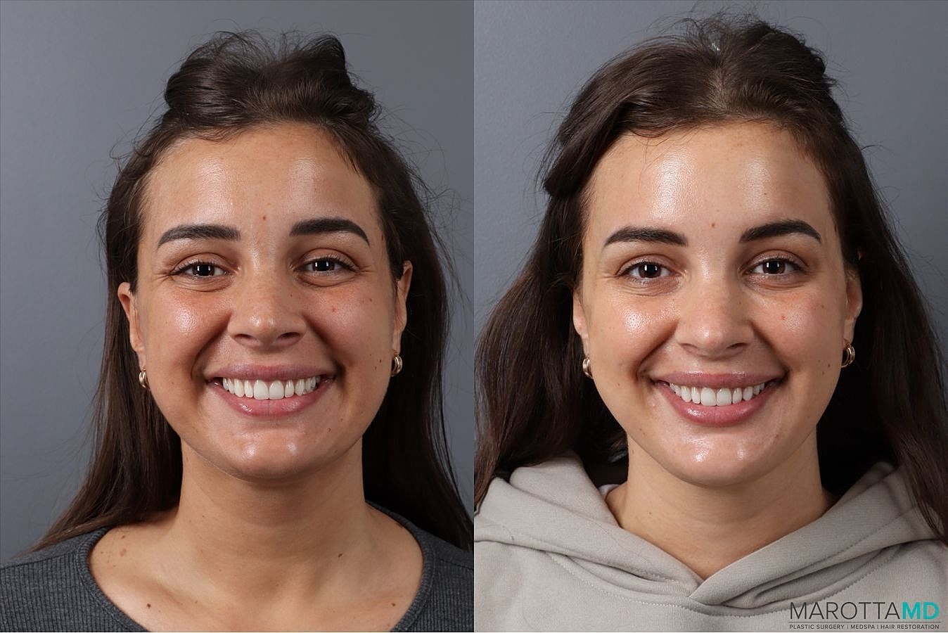 Botox Before & After