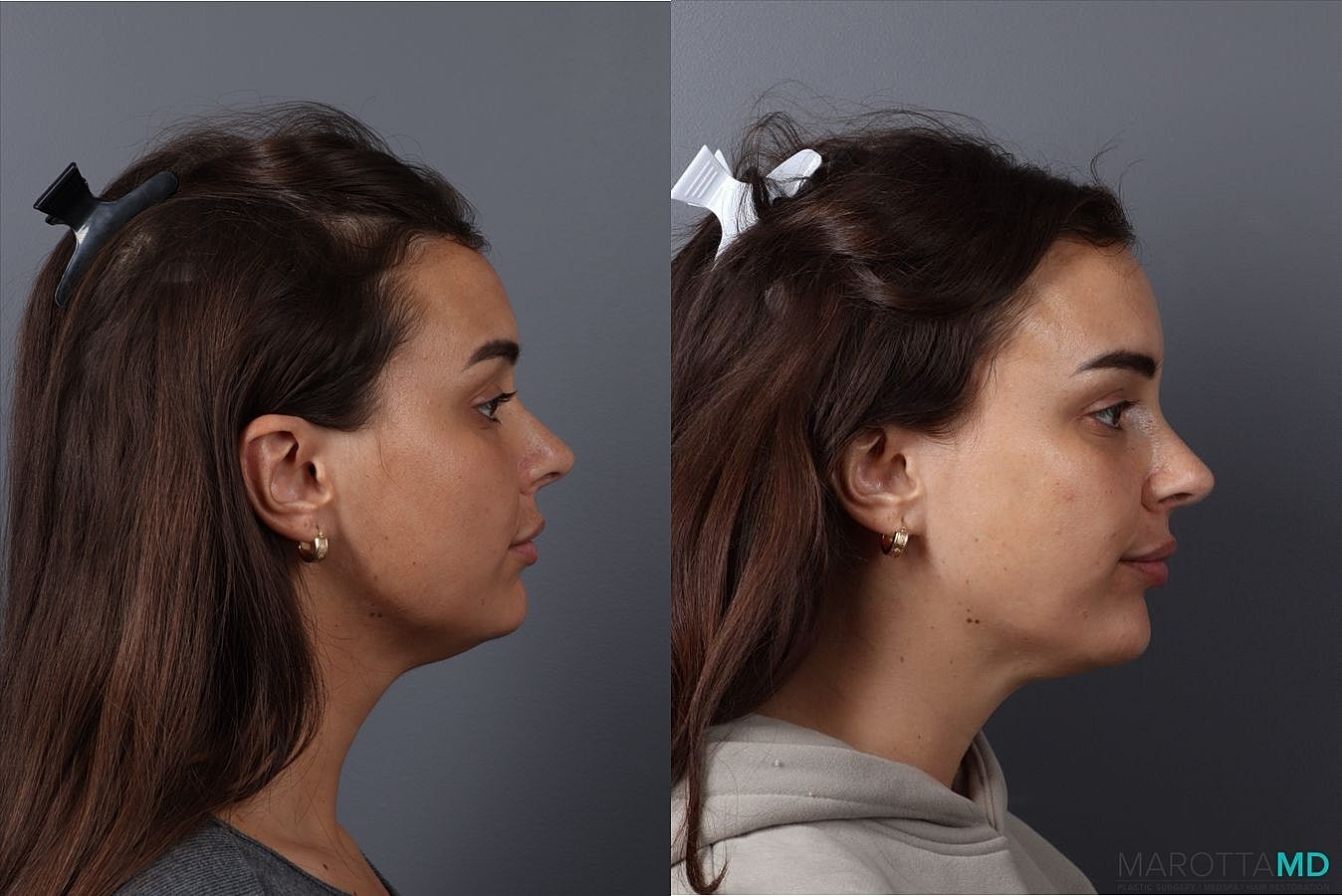 Botox Before & After