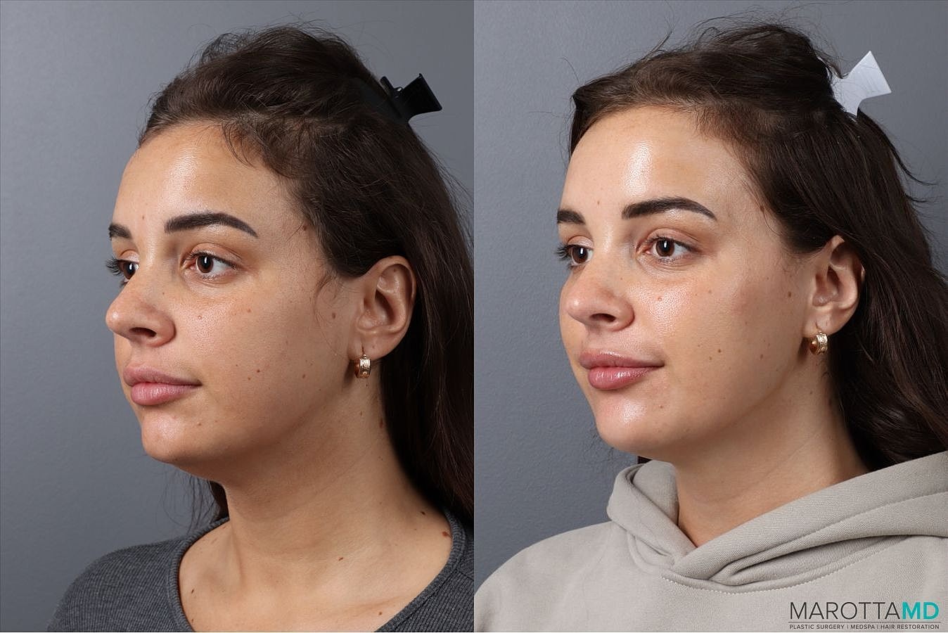 Botox Before & After