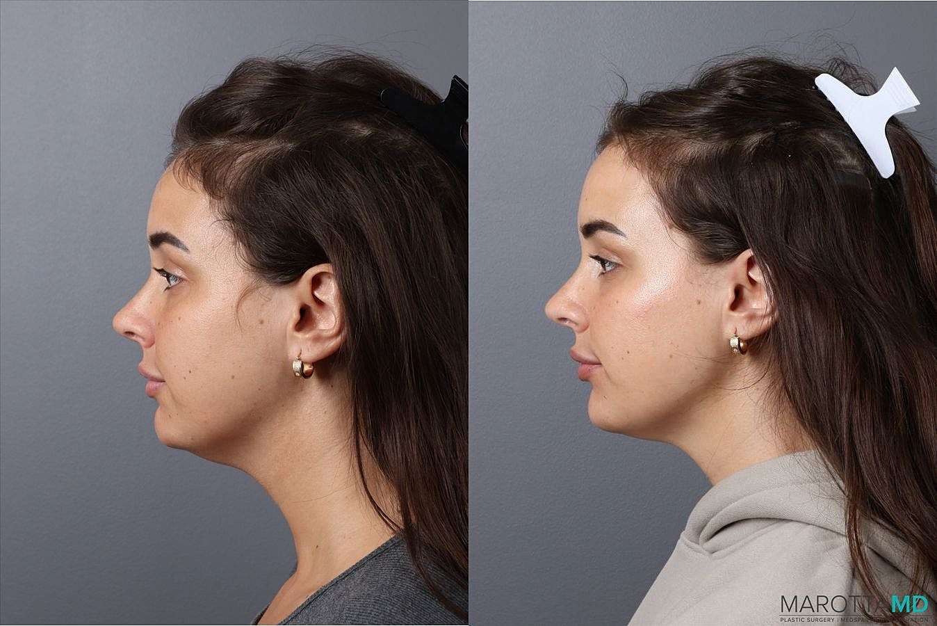 Botox Before & After