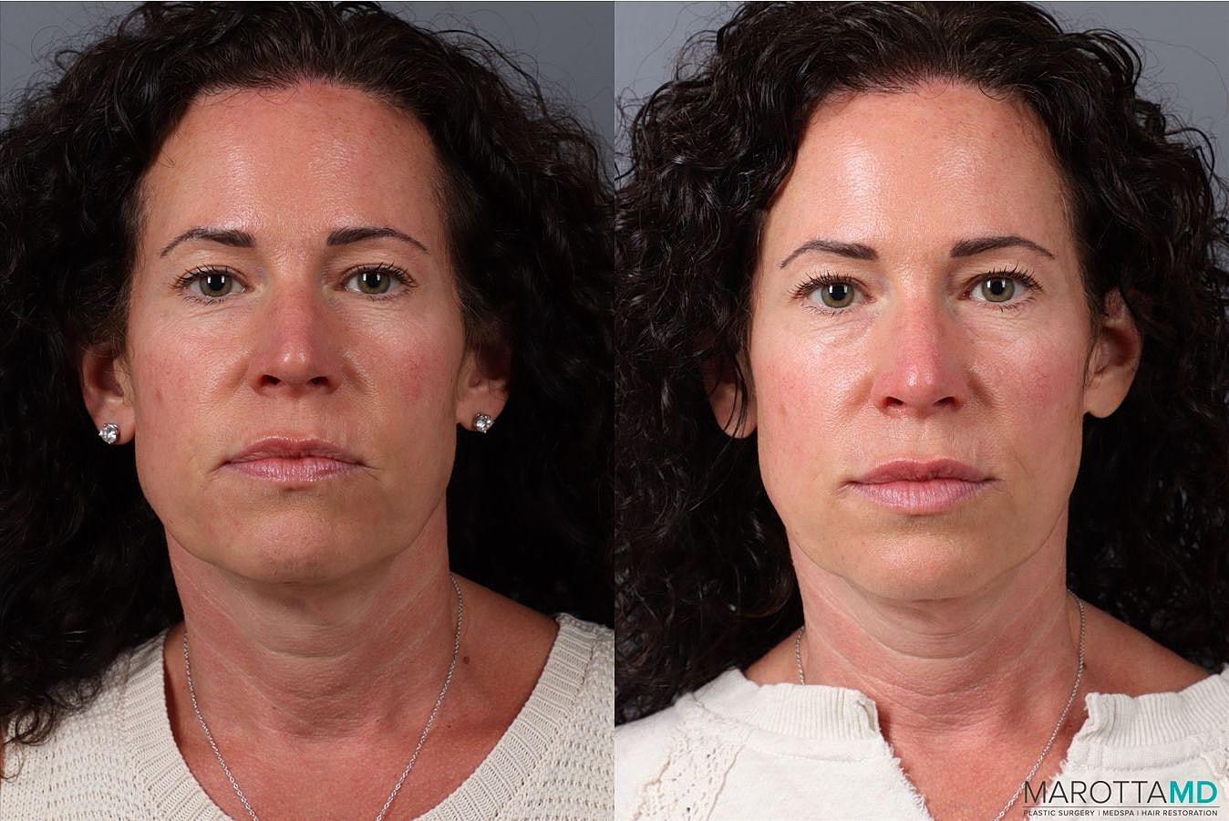 Botox Before & After
