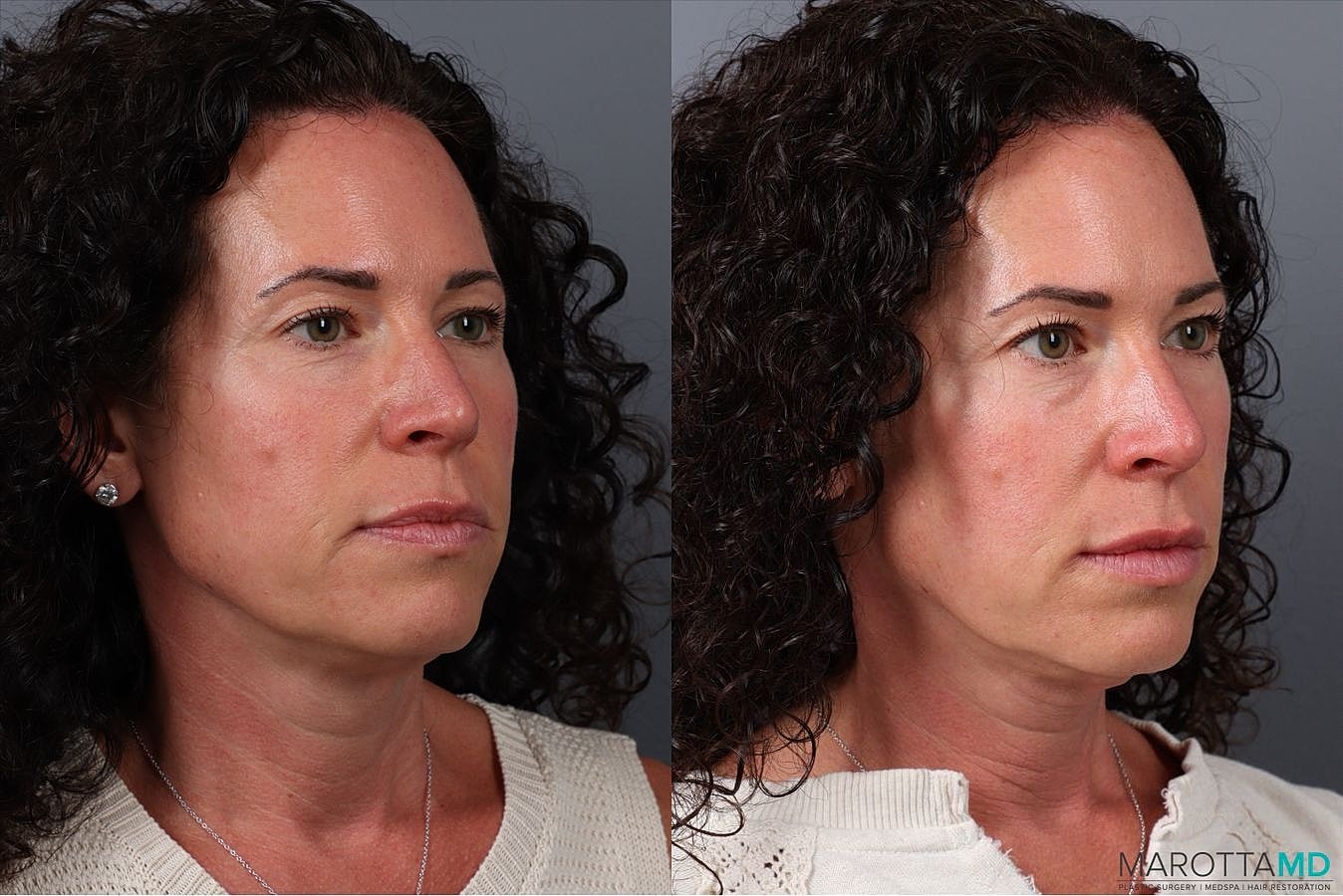 Botox Before & After