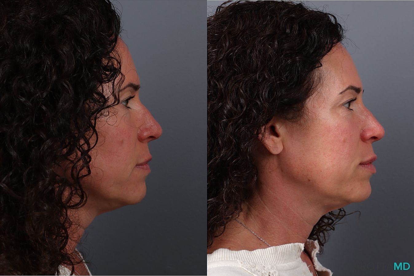 Botox Before & After