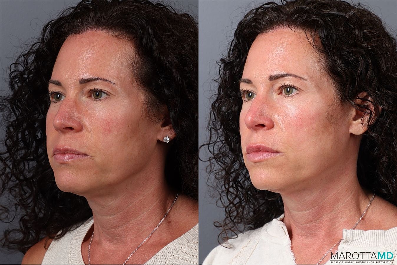 Botox Before & After