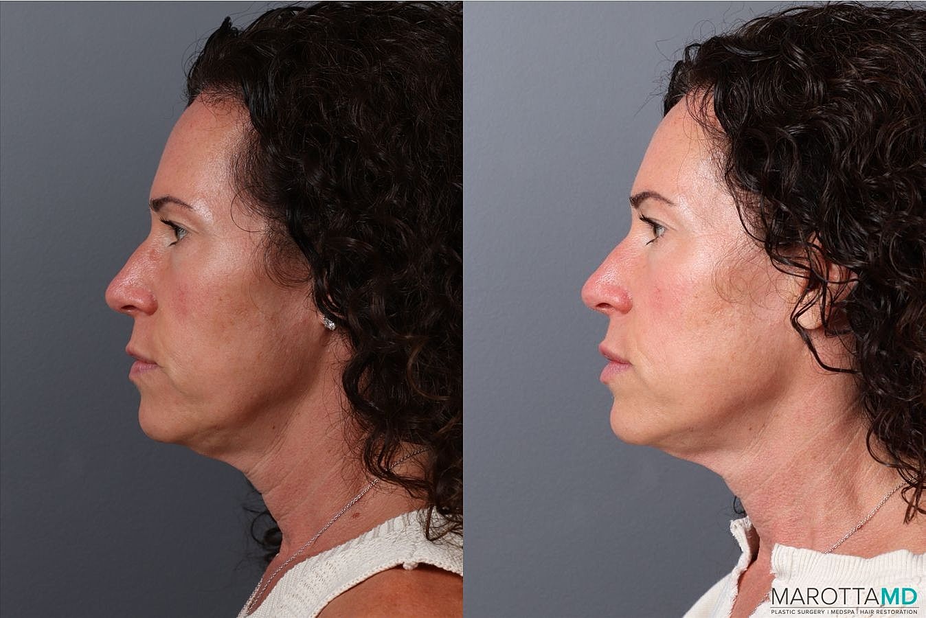 Botox Before & After