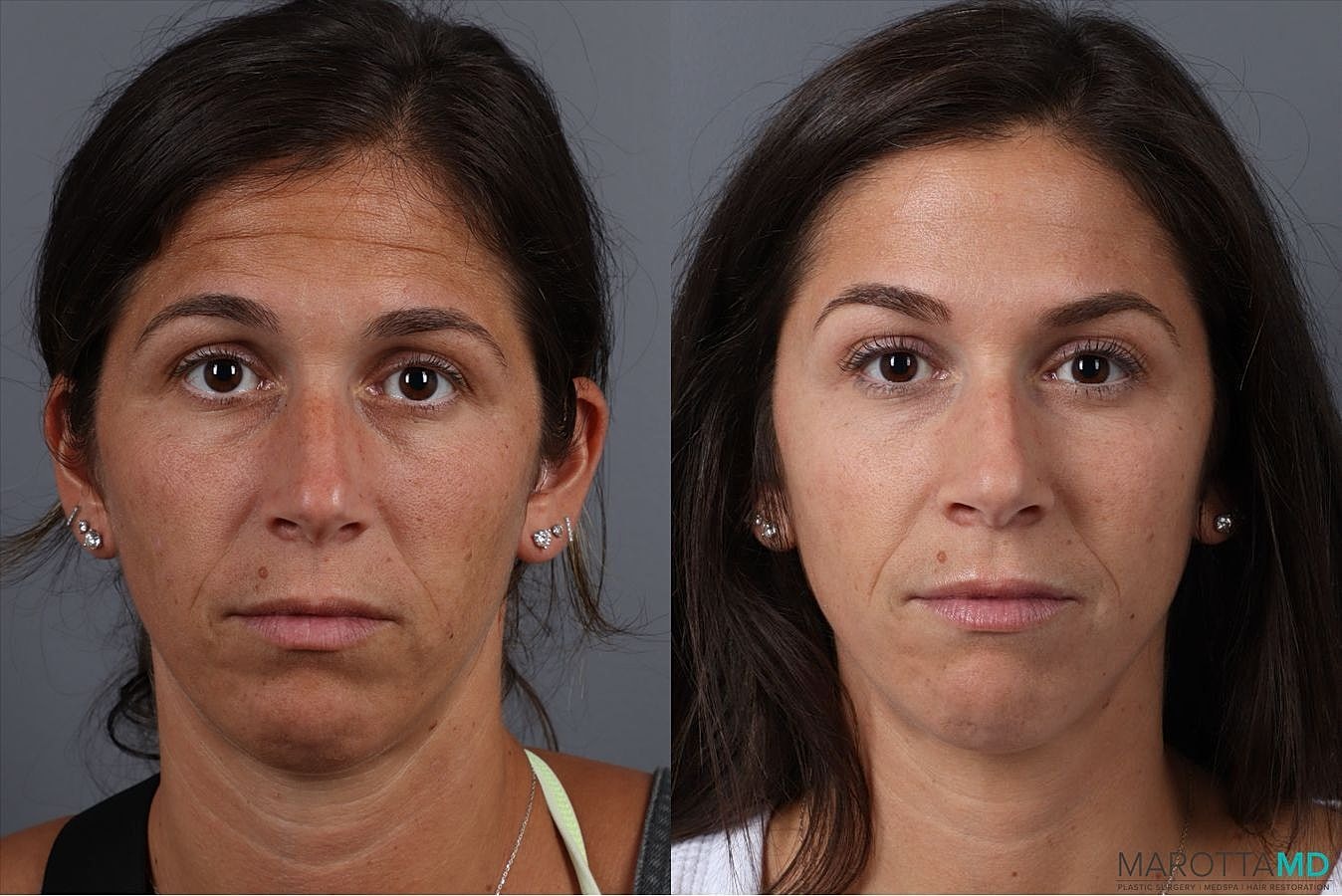 Botox Before & After