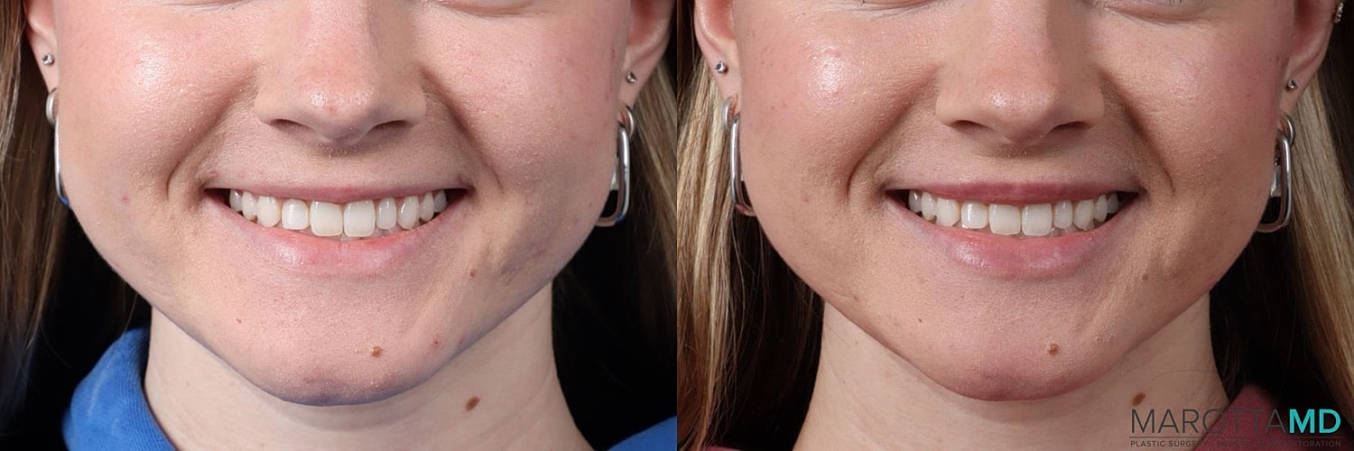 Botox Before & After
