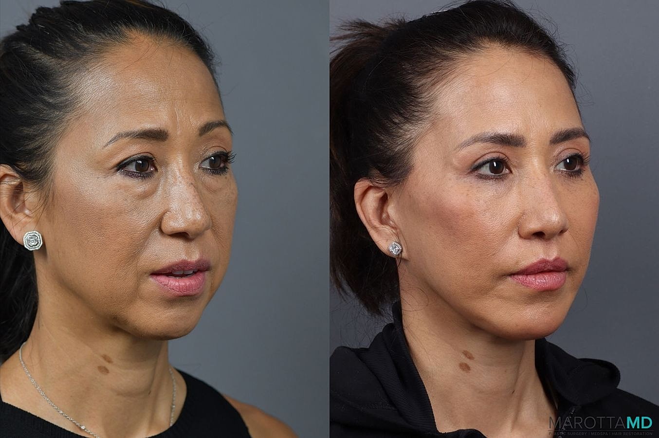 Lip Lift Before & After