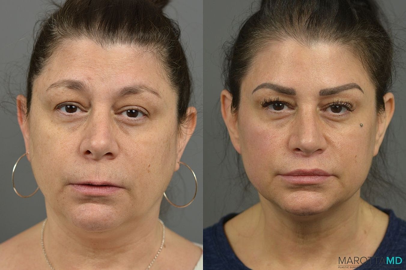 Lip Lift Before & After