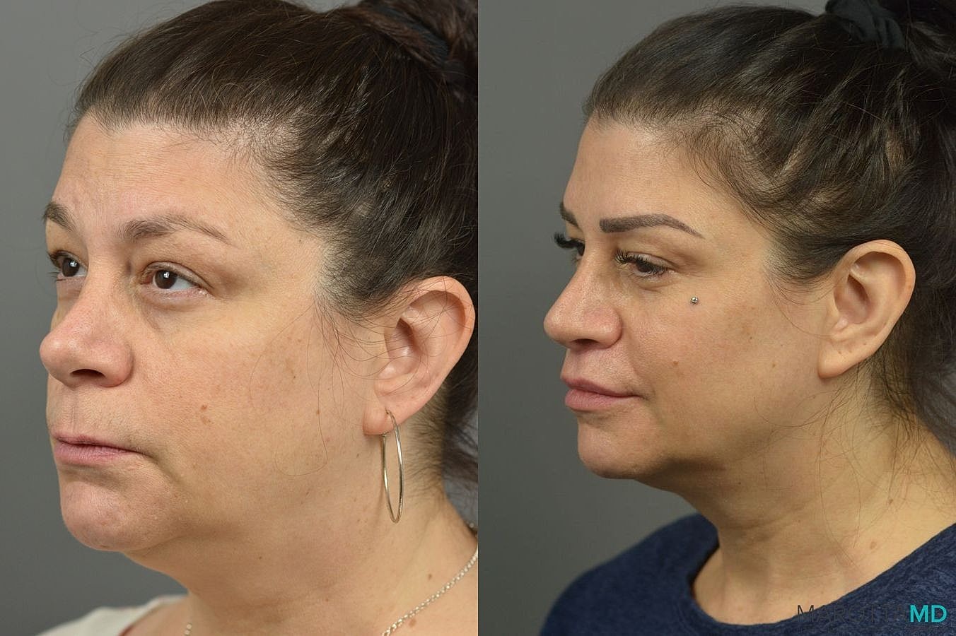 Lip Lift Before & After