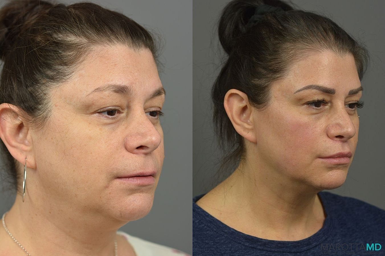 Lip Lift Before & After
