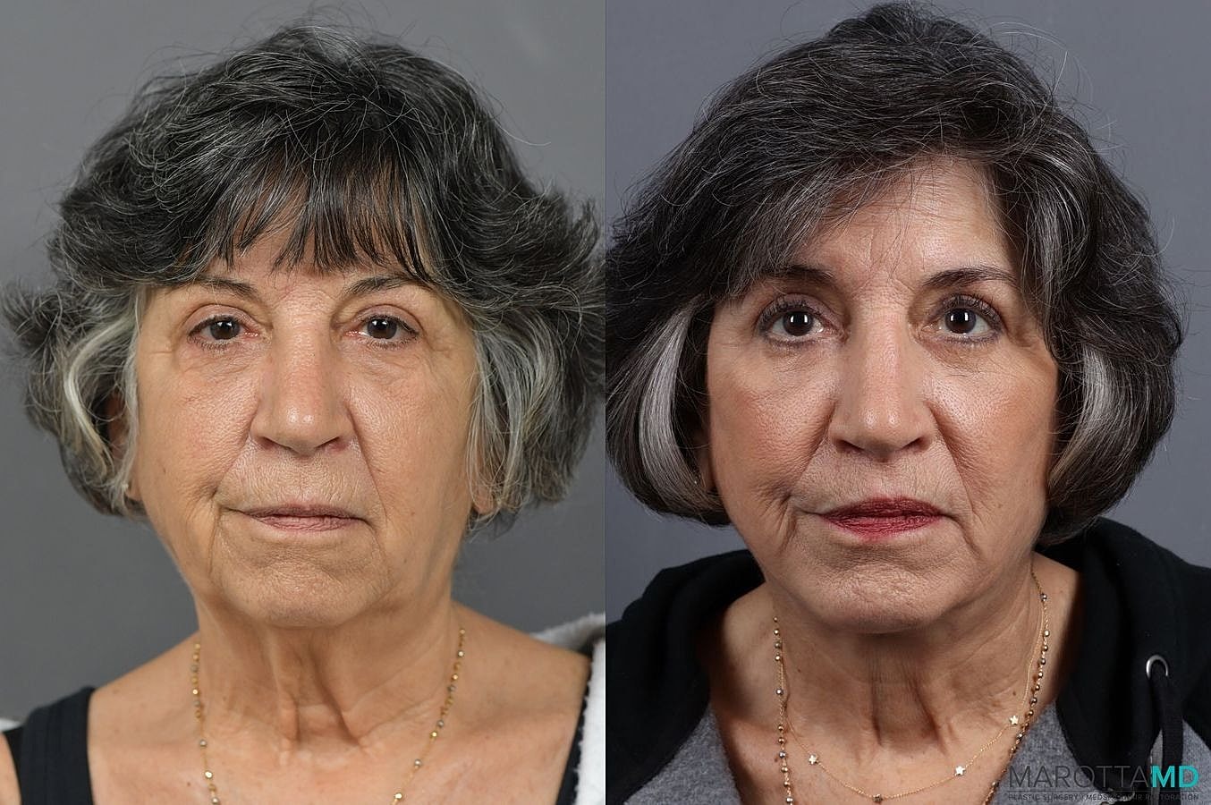 Lip Lift Before & After