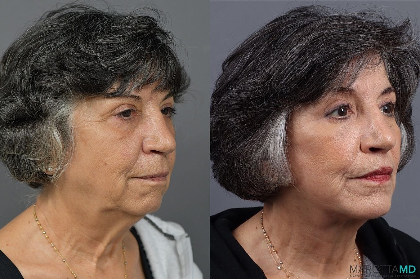 Lip Lift Before & After