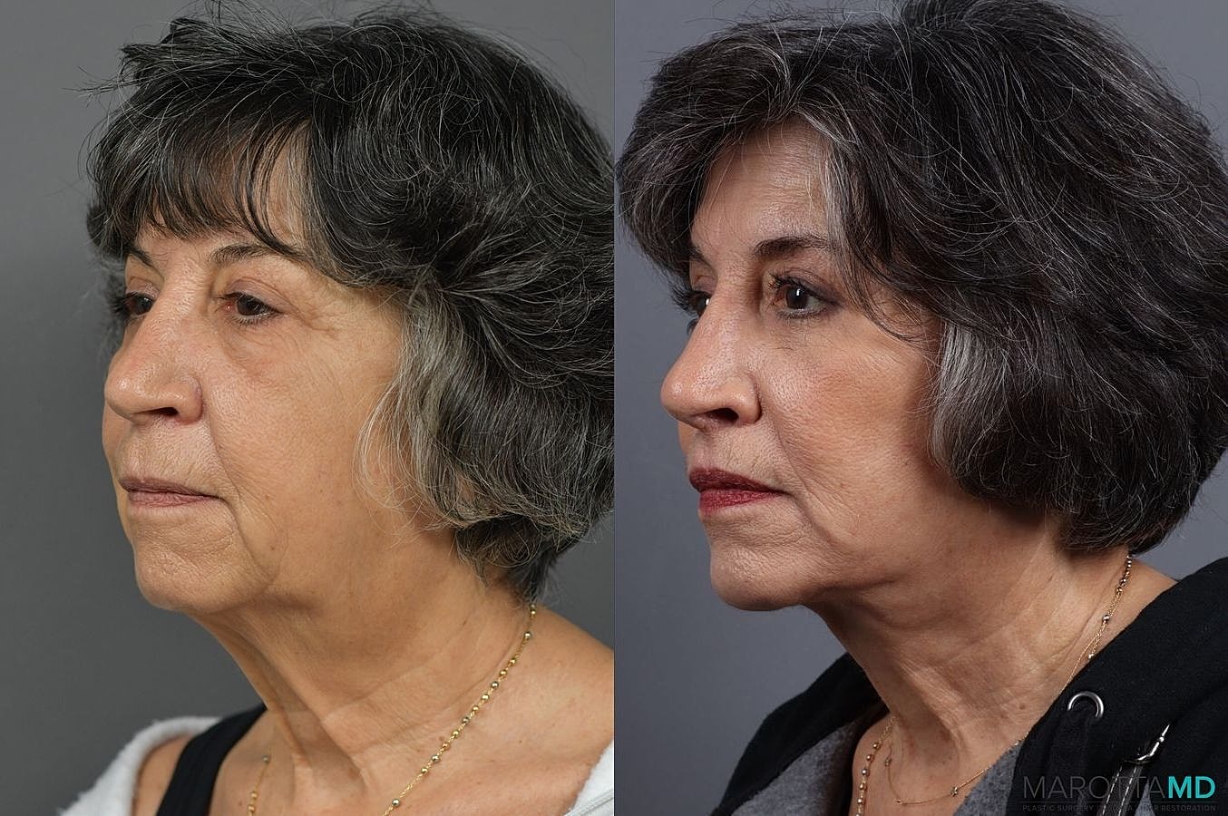 Lip Lift Before & After