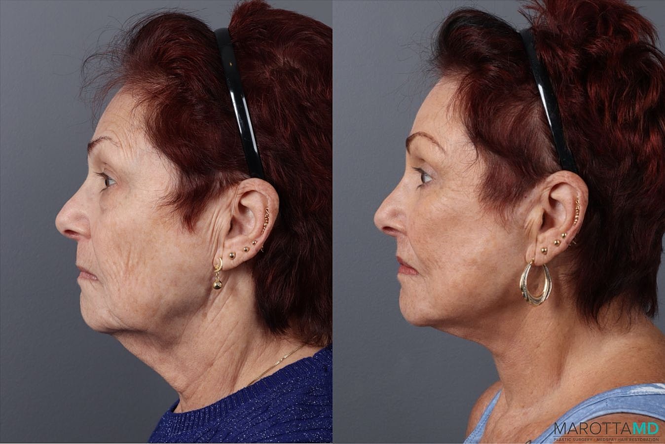 Lip Lift Before & After