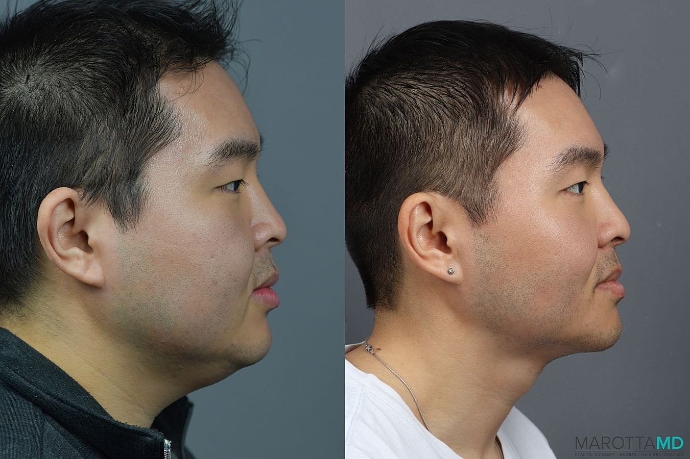 Renuvion Before & After