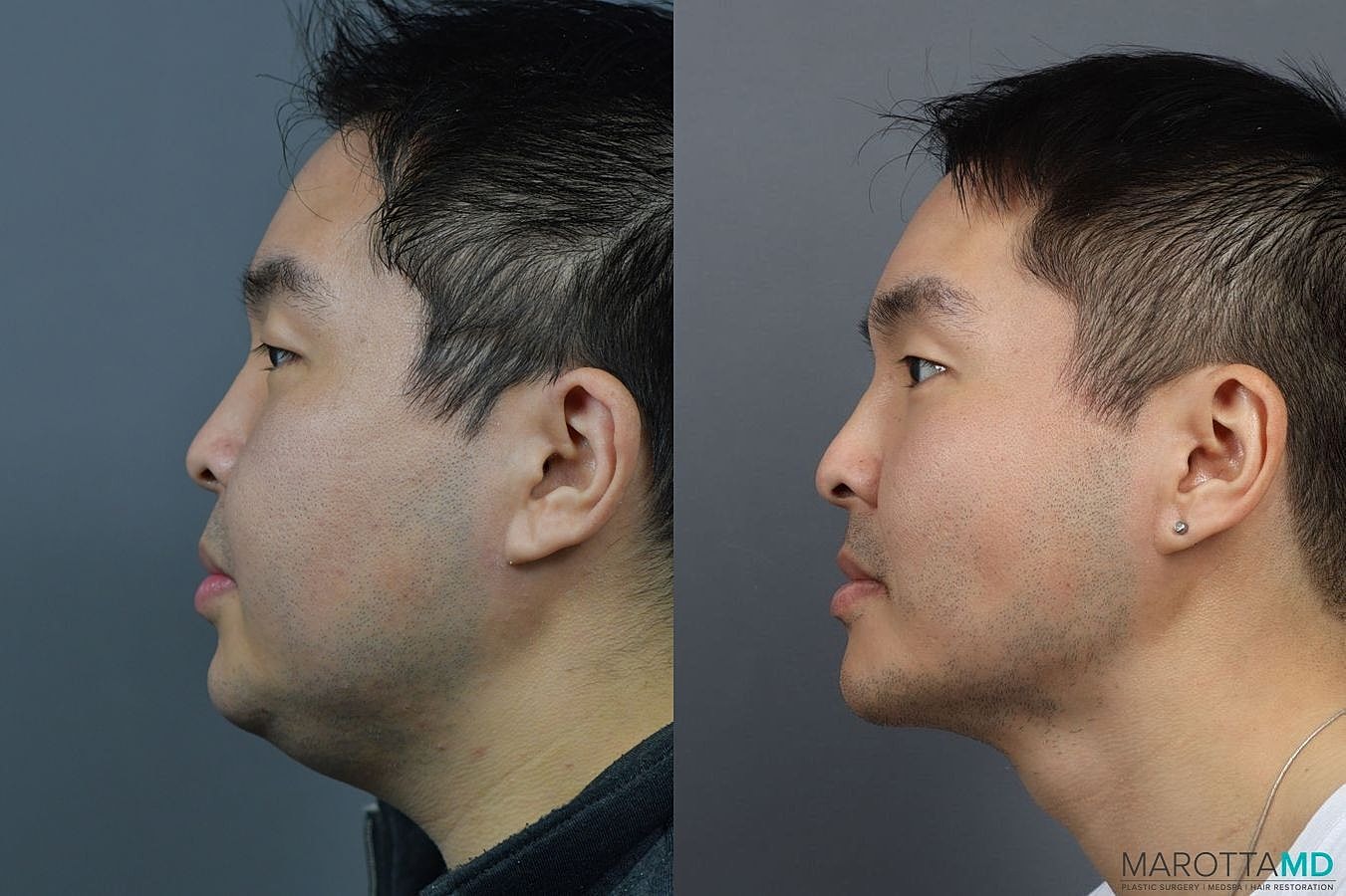 Renuvion Before & After