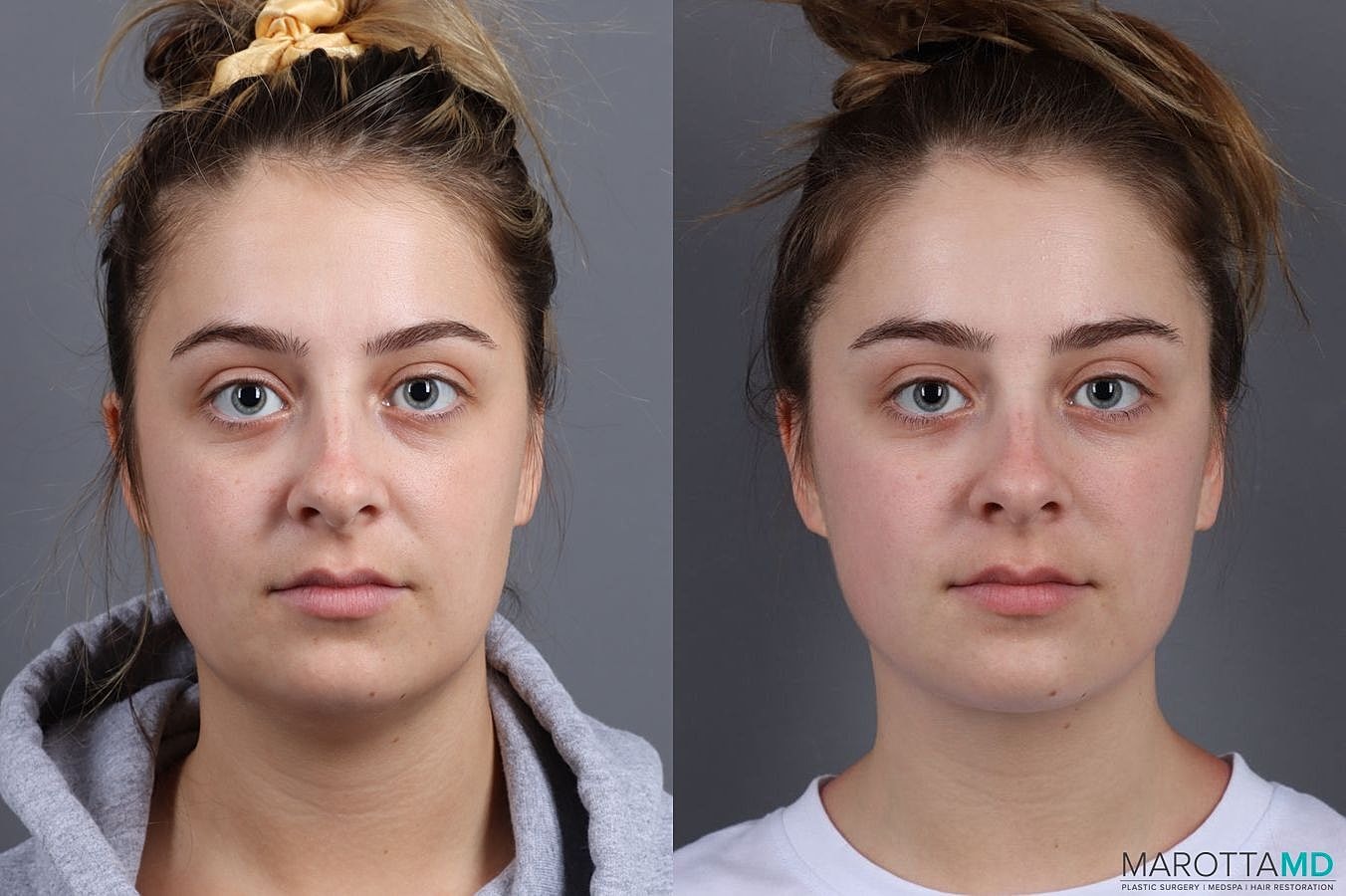 Renuvion Before & After