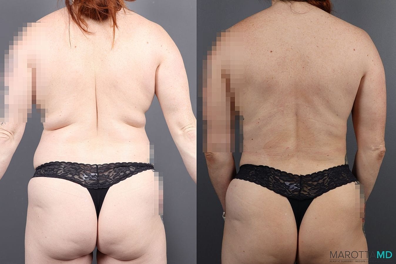 Renuvion Before & After