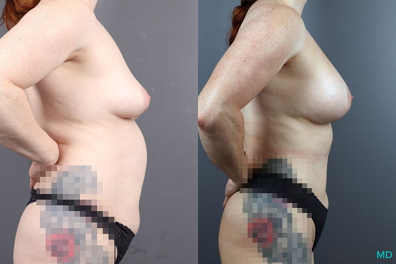 Renuvion Before & After
