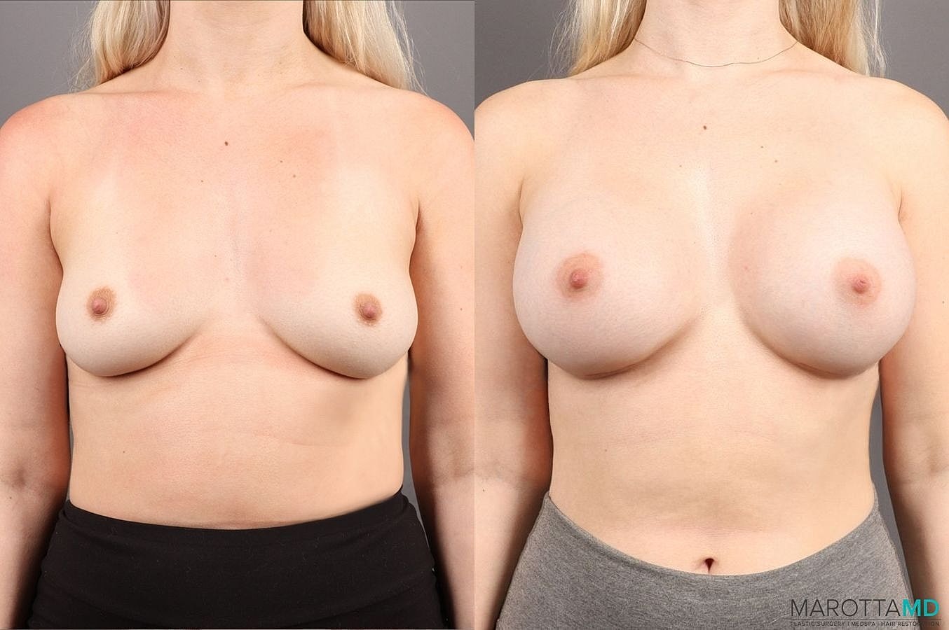 Breast Augmentation Before & After