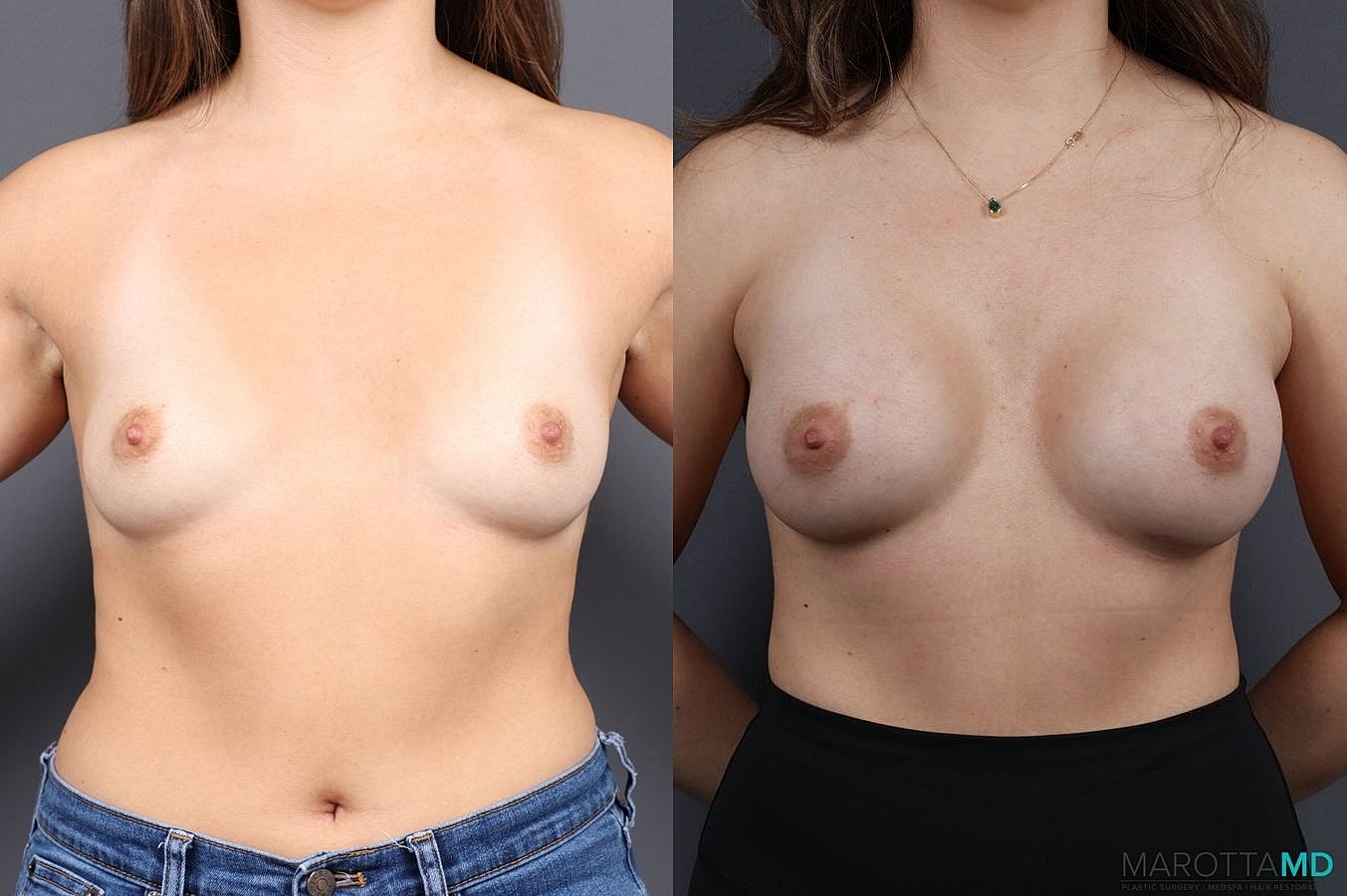 Breast Augmentation Before & After