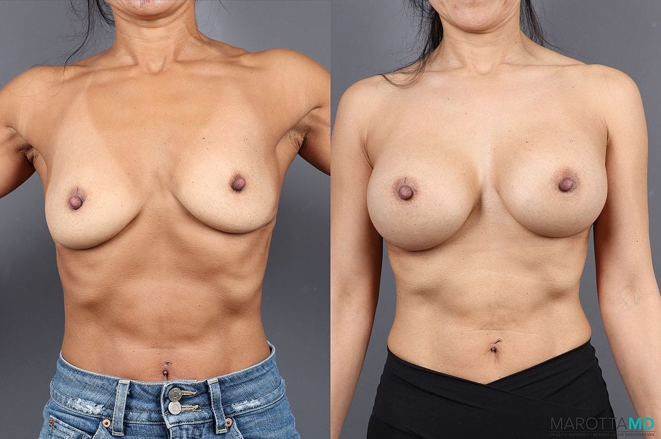 Breast Augmentation Before & After